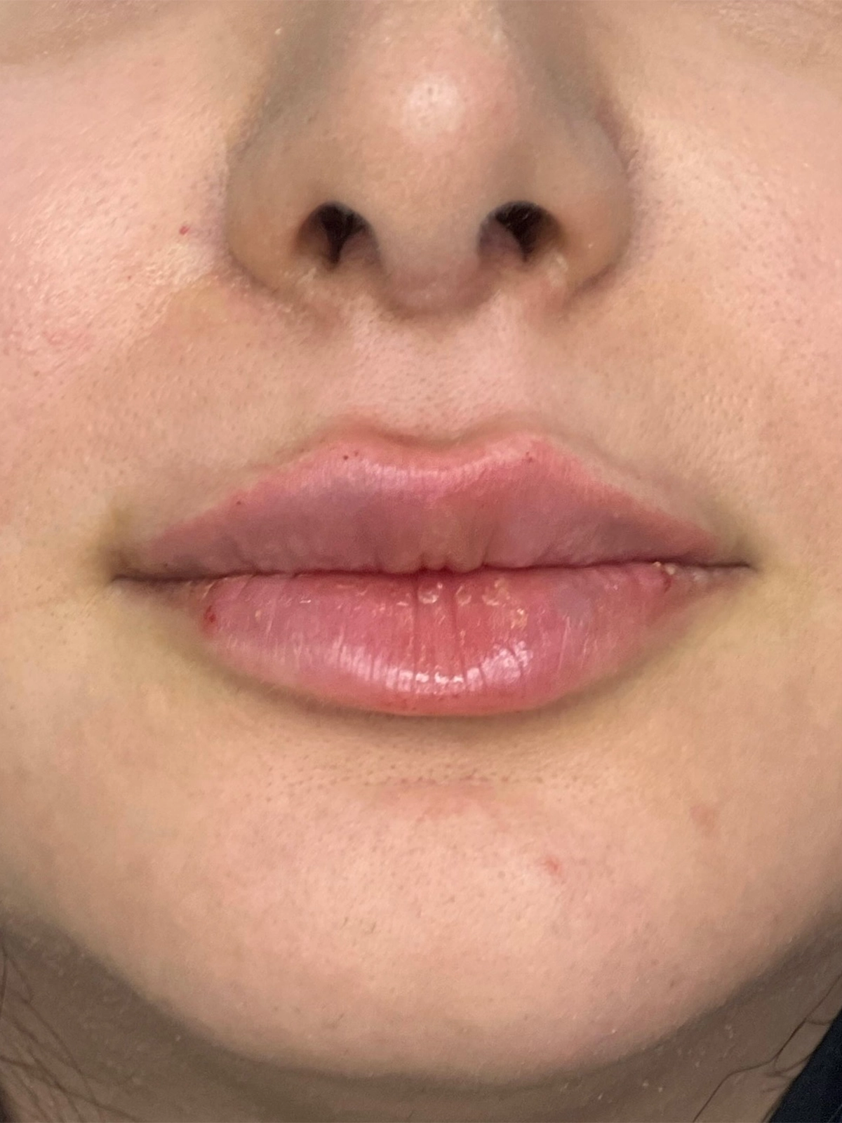 نمونه فعالیت بعد از تزریق ژل مطب دکتر وارسته رشت