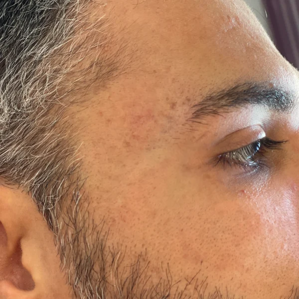 نمونه فعالیت زخم آکنه مطب دکتر سعید وارسته