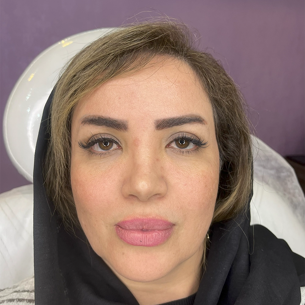 نمونه بعد از لیفت با نخ مطب دکتر وارسته رشت ۲