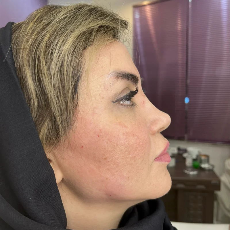 نمونه فعالیت لیفت با نخ مطب دکتر سعید وارسته