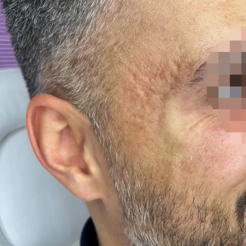 نمونه فعالیت زخم آکنه مطب دکتر سعید وارسته