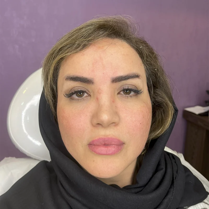 نمونه قبل از لیفت با نخ مطب دکتر وارسته رشت ۲