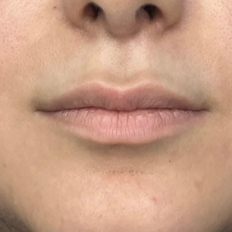 نمونه فعالیت قبل از تزریق ژل بع لب مطب دکتر وارسته رشت