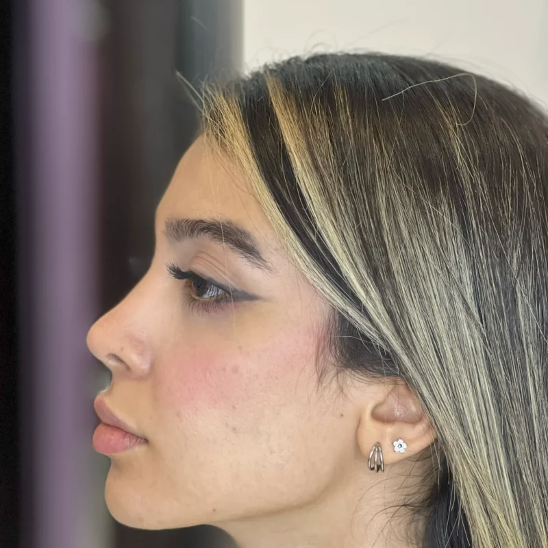 فیلر چانه و فک مطب دکتر وارسته