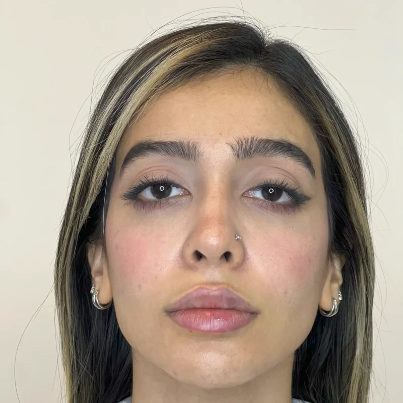 فیلر فک و چانه مطب دکتر وارسته